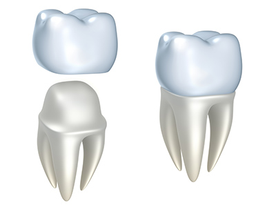 Rendered image of dental crowns at Palo Alto Oral Health, Palo Alto, CA