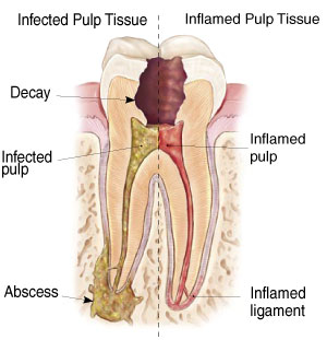 Root Canal Therapy Diagram by Palo Alto Oral Health 