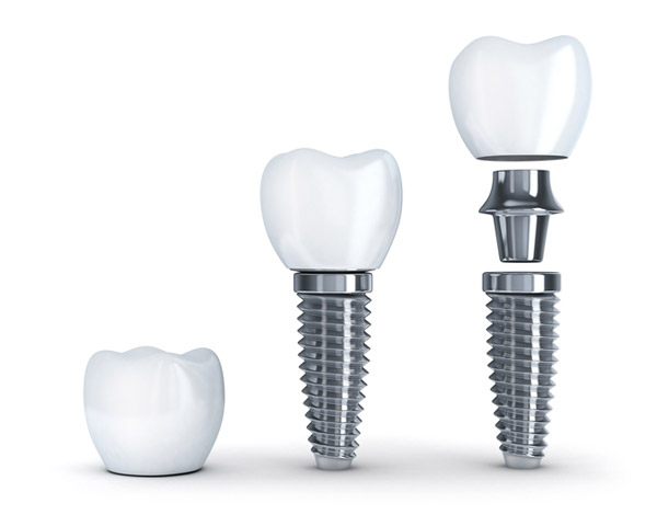 Dental Implant  from Palo Alto Oral Health in Palo Alto , CA